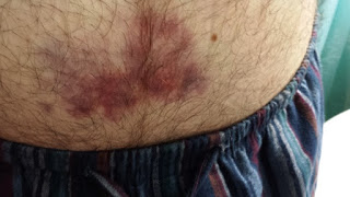 https://2.bp.blogspot.com/-nG4wgxw0rzY/V0NCdzqsilI/AAAAAAAAOL0/Hm9MPbF85wQ3c-jGwvILAJSdSvIL1jIUACLcB/s320/bruise.jpg